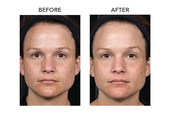 woman before and after clear + brilliant facial treatment