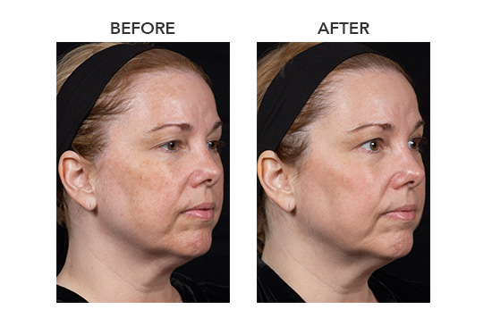 woman before and after clear + brilliant facial treatment