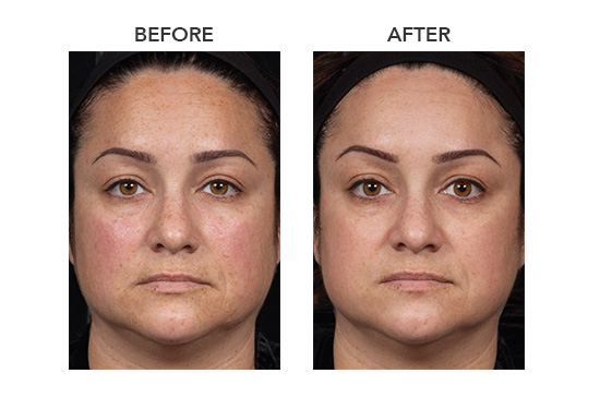 woman before and after clear + brilliant facial treatment