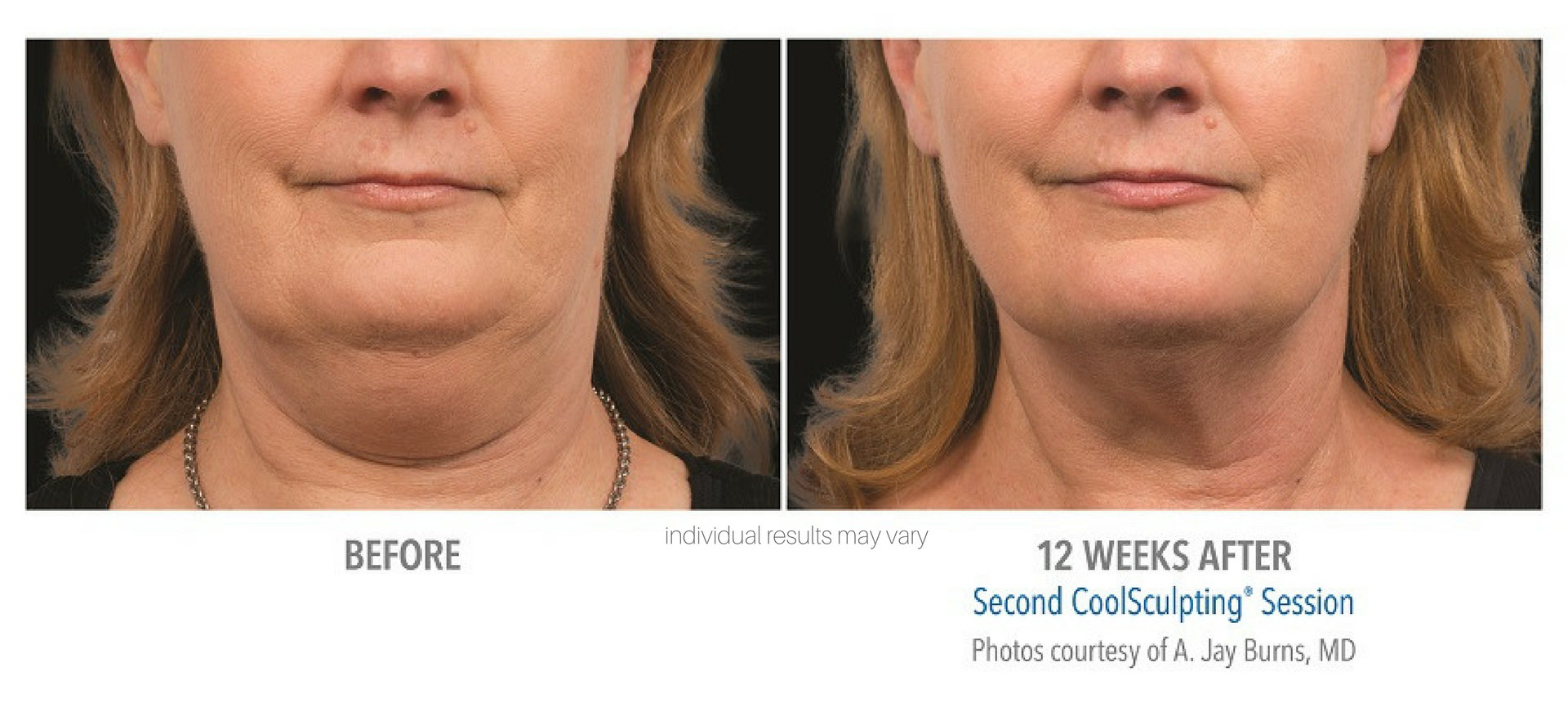 Woman's before and after results from CoolSculpting to chin area.