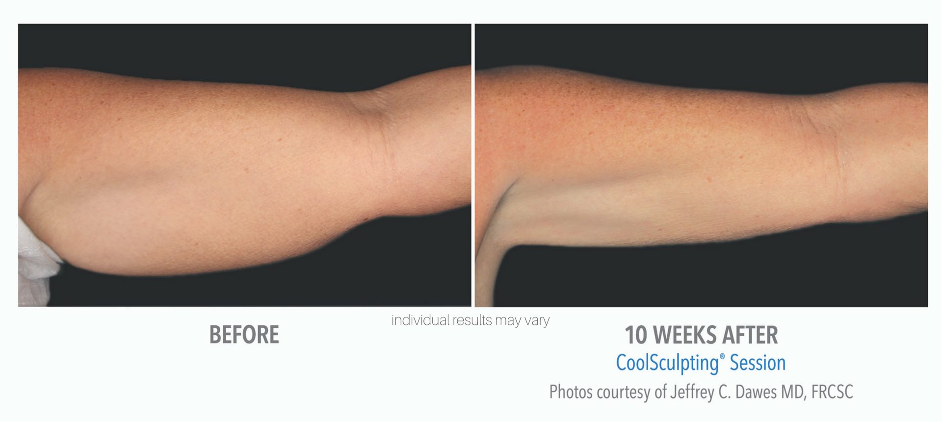 Coolsculpting before and after of under arm treatment at Laser + Skin Institute in Chatham, NJ.