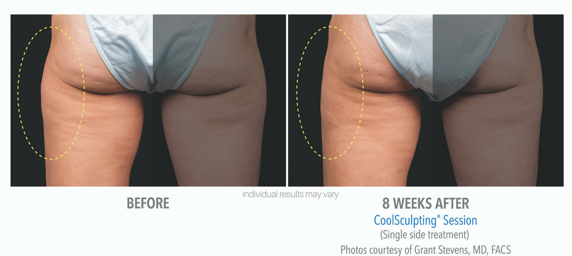 Coolsculpting before and after of banana roll and thighs at Laser + Skin Institute in Chatham, NJ.