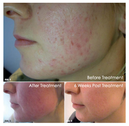 Real patients results showing before, after treatment, and six weeks after microneedling treatment.