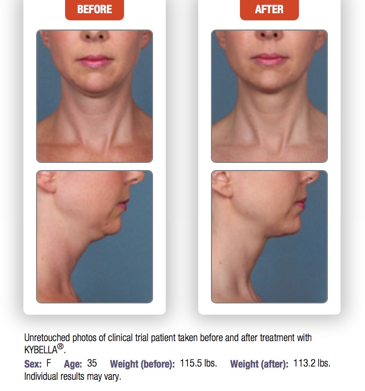 Woman's before and after results to chin area from kybella treatment.
