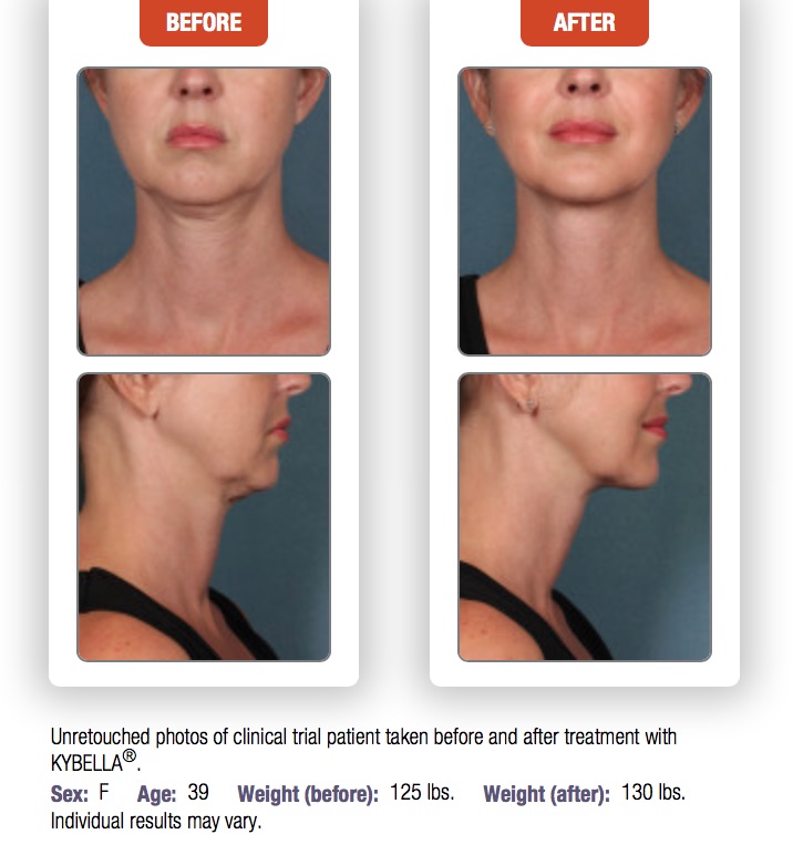 Woman's before and after results from Kybella treatment to chin area.