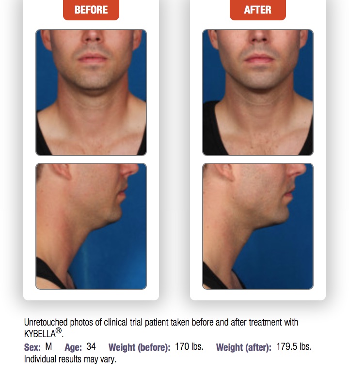 Man's before and after results from Kybella treatment to the chin.