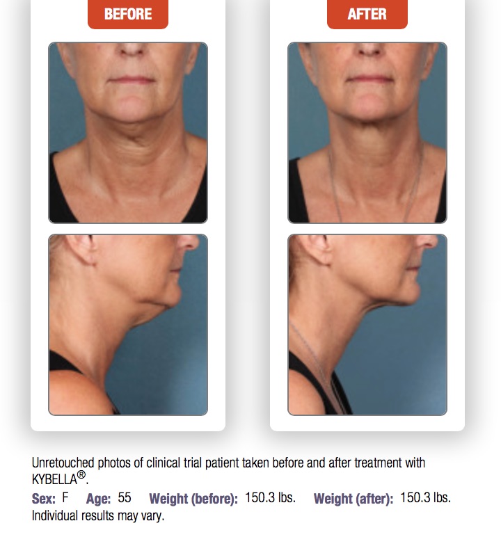 Woman's before and after results from Kybella treatment to chin area.