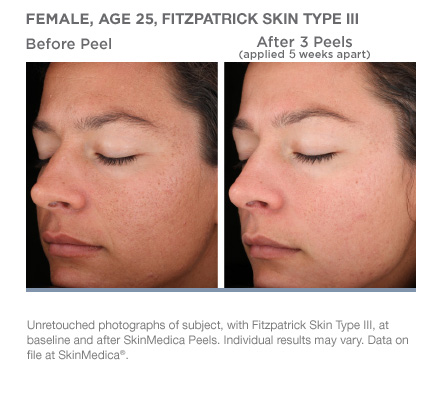 Woman's before and after results from three treatments spread five weeks apart of Rejuvenize Peel.