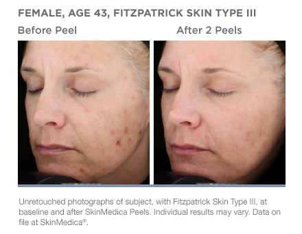 Real before and after results from a vitalize peel.