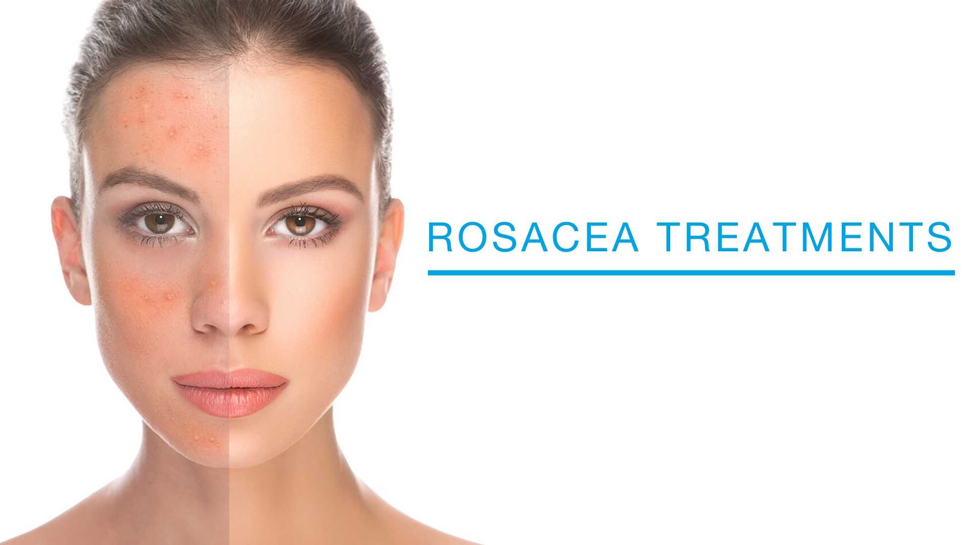 Woman's before and after split comparison after rosacea treatment.