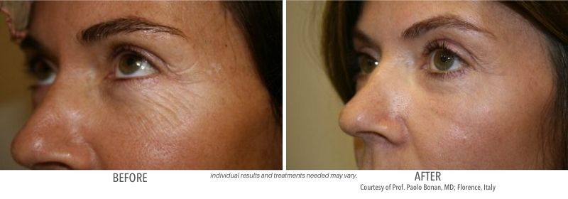 CoolPeel before and after Laser and Skin Institute Chatham