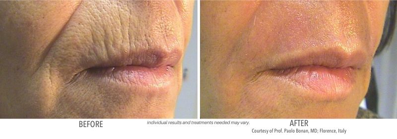 CoolPeel™ with Tetra CO2 before and after Chatham, NJ