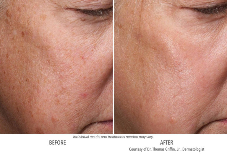 Subnovii Plasma before and after Laser and Skin Institute Chatham