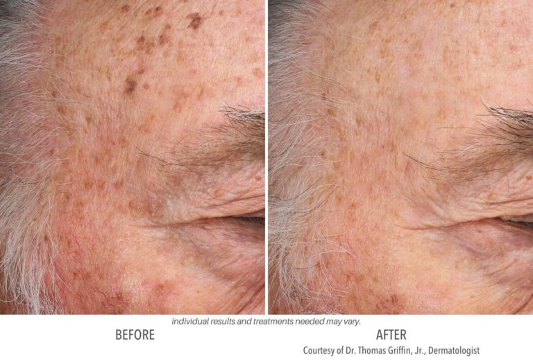 SUBNOVII PLASMA PEN NONSURGICAL REJUVENATION