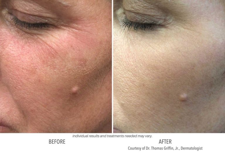 Subnovii Plasma before and after Laser and Skin Institute
