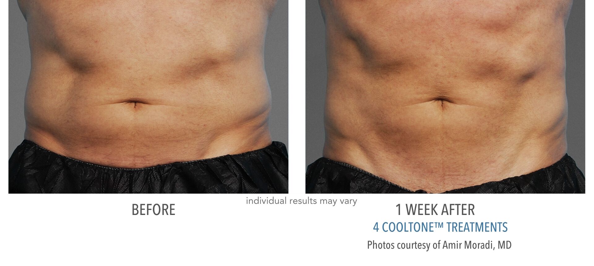 Cooltone results for male abdomen before and after at Laser + Skin Institute in Chatham, New Jersey.
