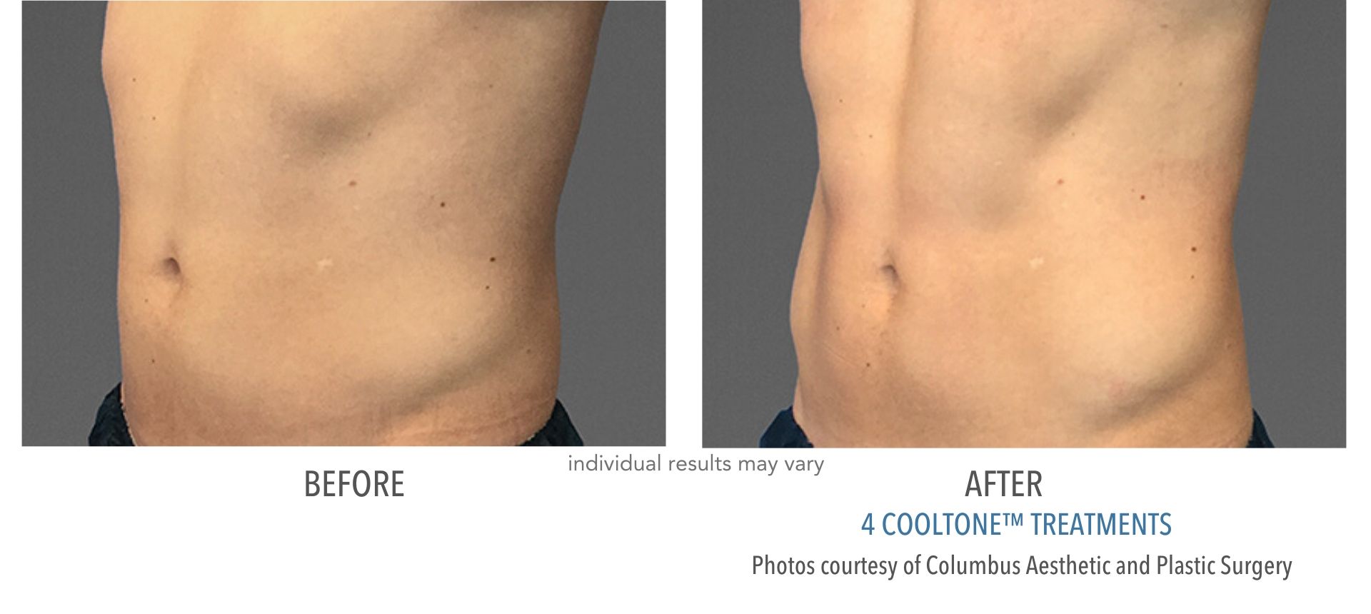 Cooltone results of male's stomach before and after at Laser + Skin Institute in Chatham, New Jersey.