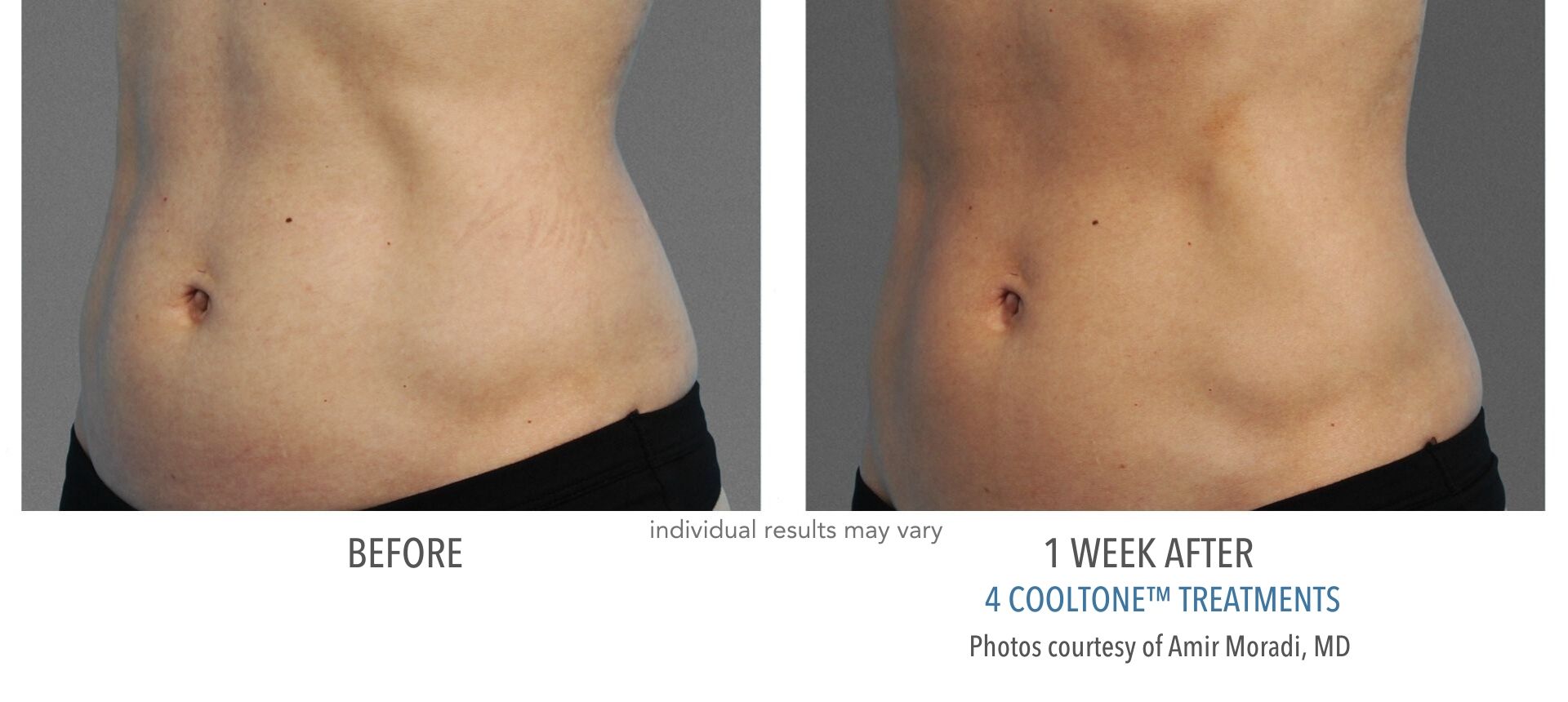Cooltone results for female abdomen before and after at Laser + Skin Institute in Chatham, New Jersey