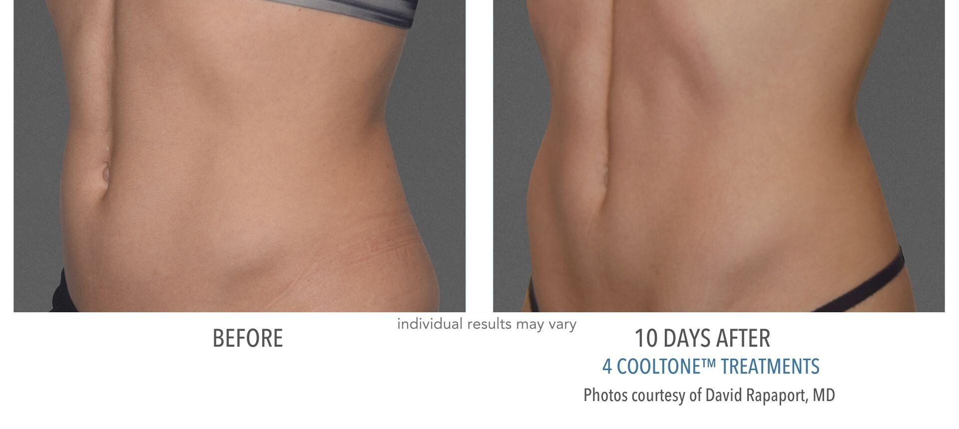 Cooltone results of female stomach before and after at Laser + Skin Institute in Chatham, New Jersey.