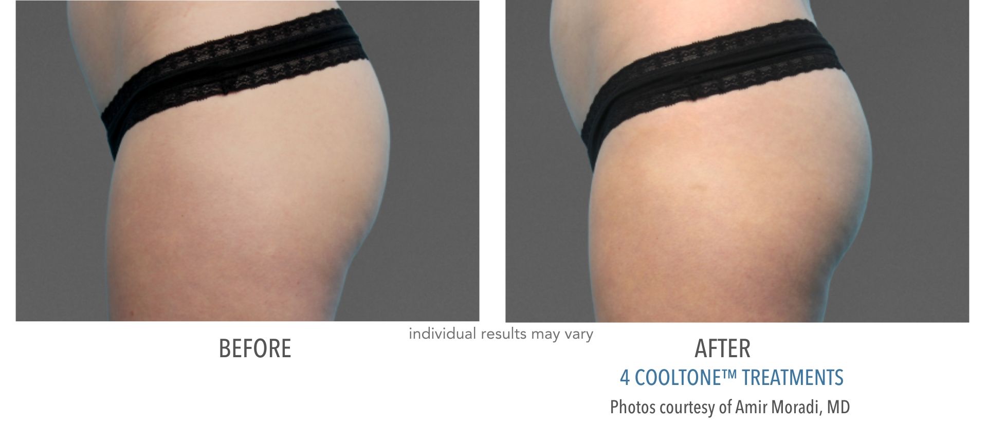 Cooltone results of female buttocks before and after at Laser + Skin Institute in Chatham, New Jersey.