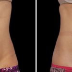 coolsculpting before and after Laser + Skin Institute in Chatham, NJ