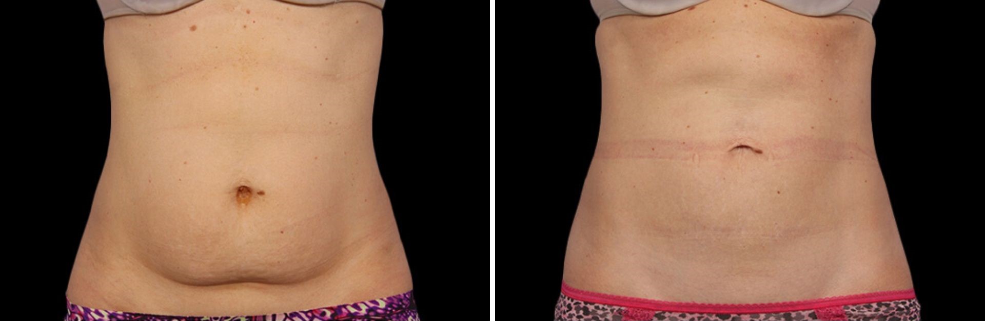 coolsculpting before and after Laser + Skin Institute in Chatham, NJ