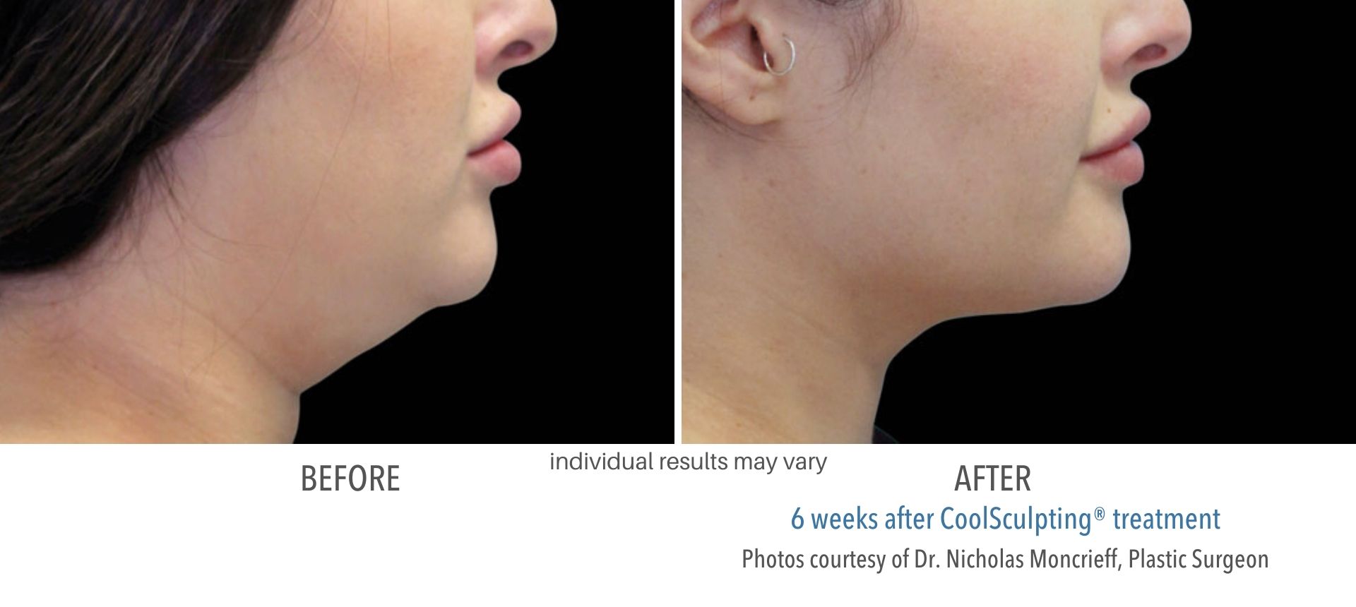 coolsculpting before and after double chin at Laser + Skin Institute in Chatham, NJ