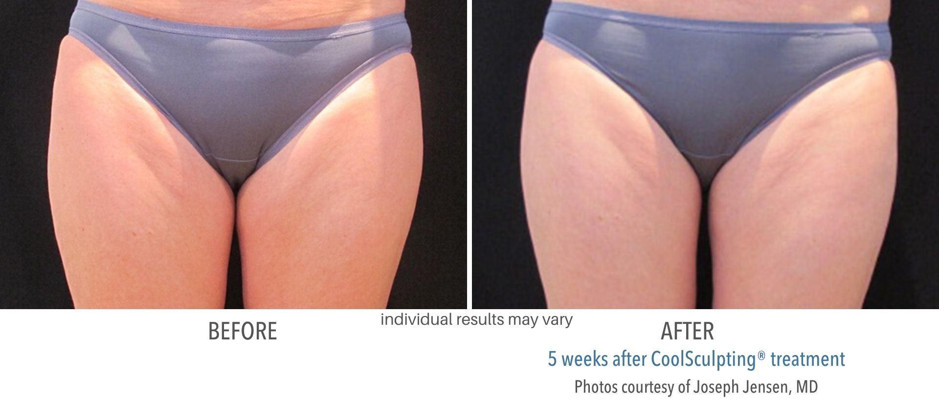 coolsculpting before and after thighs Laser + Skin Institute in Chatham, NJ