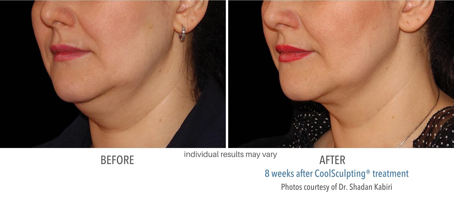 coolsculpting before and after double chin Laser + Skin Institute in Chatham, NJ