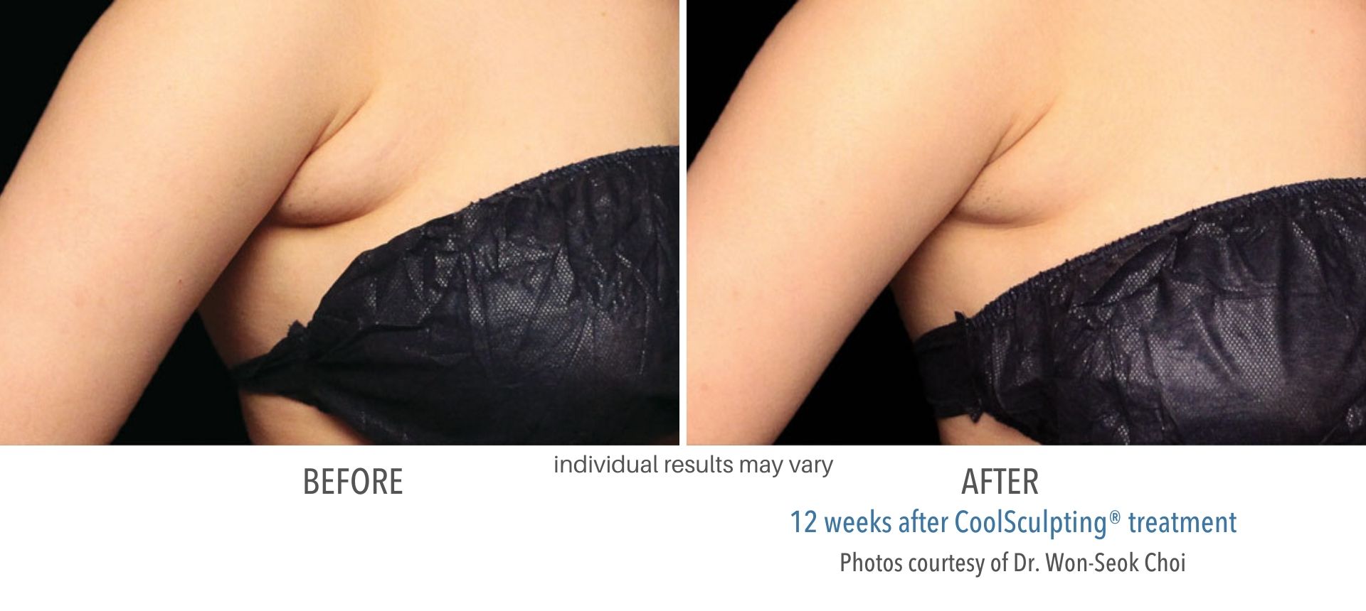 coolsculpting before and after armpit fat Laser + Skin Institute in Chatham, NJ