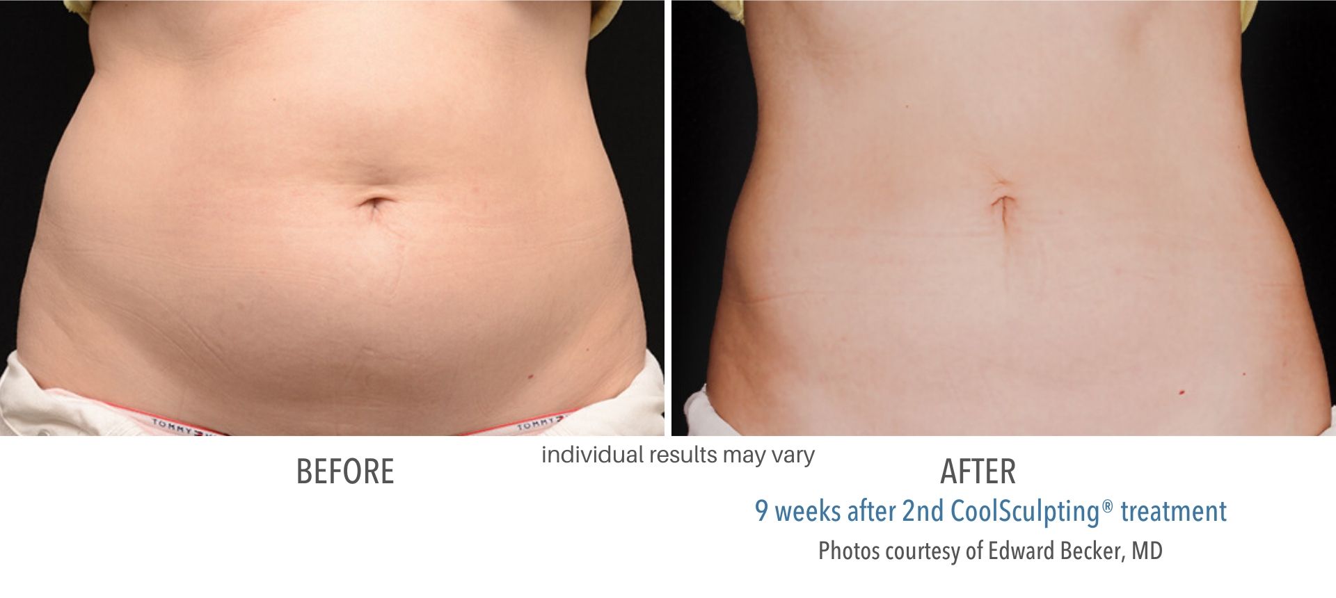 coolsculpting before and after female abdomen Laser + Skin Institute in Chatham, NJ