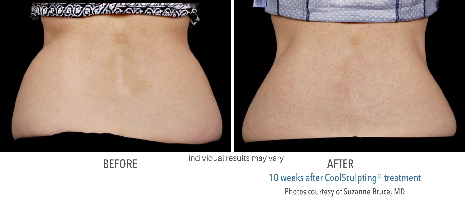 coolsculpting before and after female back fat Laser + Skin Institute in Chatham, NJ