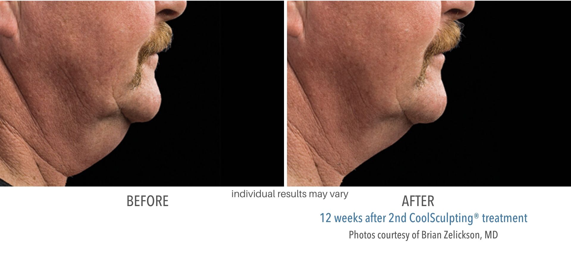 coolsculpting before and after male chin fat Laser + Skin Institute in Chatham, NJ
