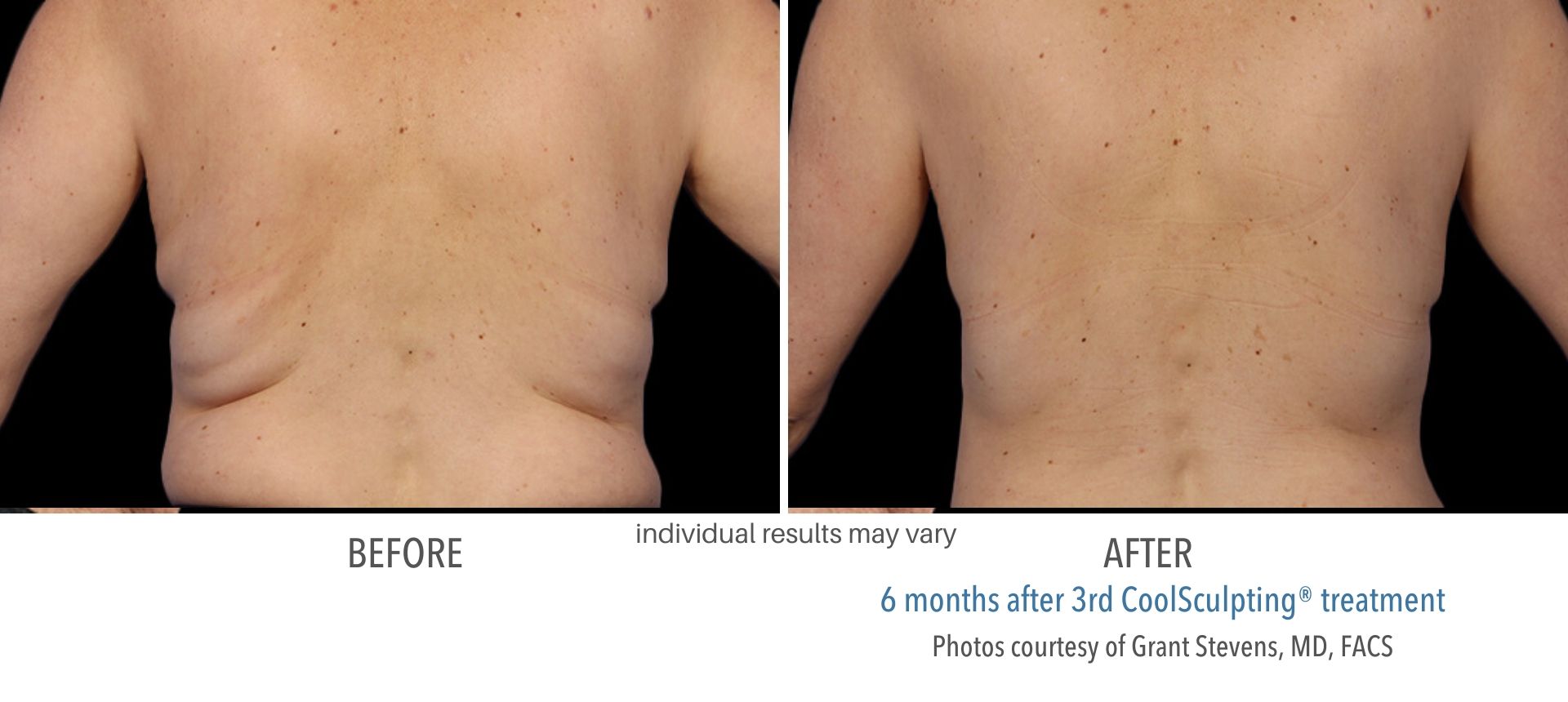 coolsculpting before and after back fat Laser + Skin Institute in Chatham, NJ