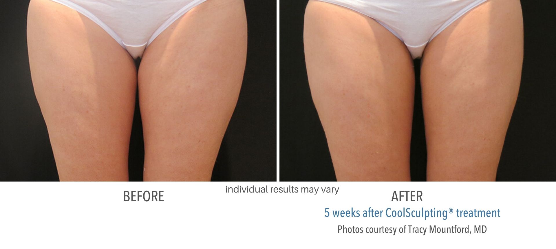 coolsculpting before and after thigh fat Laser + Skin Institute in Chatham, NJ
