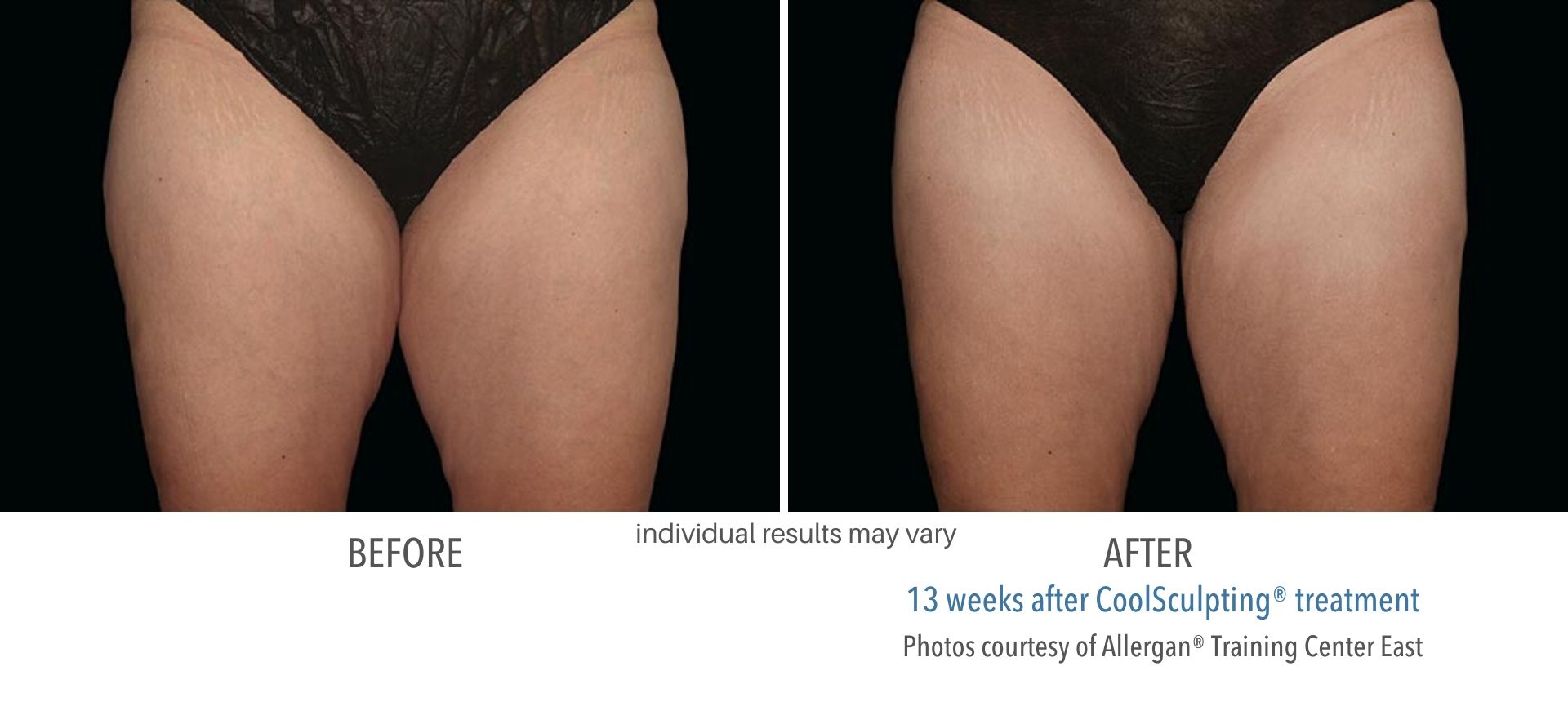 coolsculpting before and after inner thighs Laser + Skin Institute in Chatham, NJ