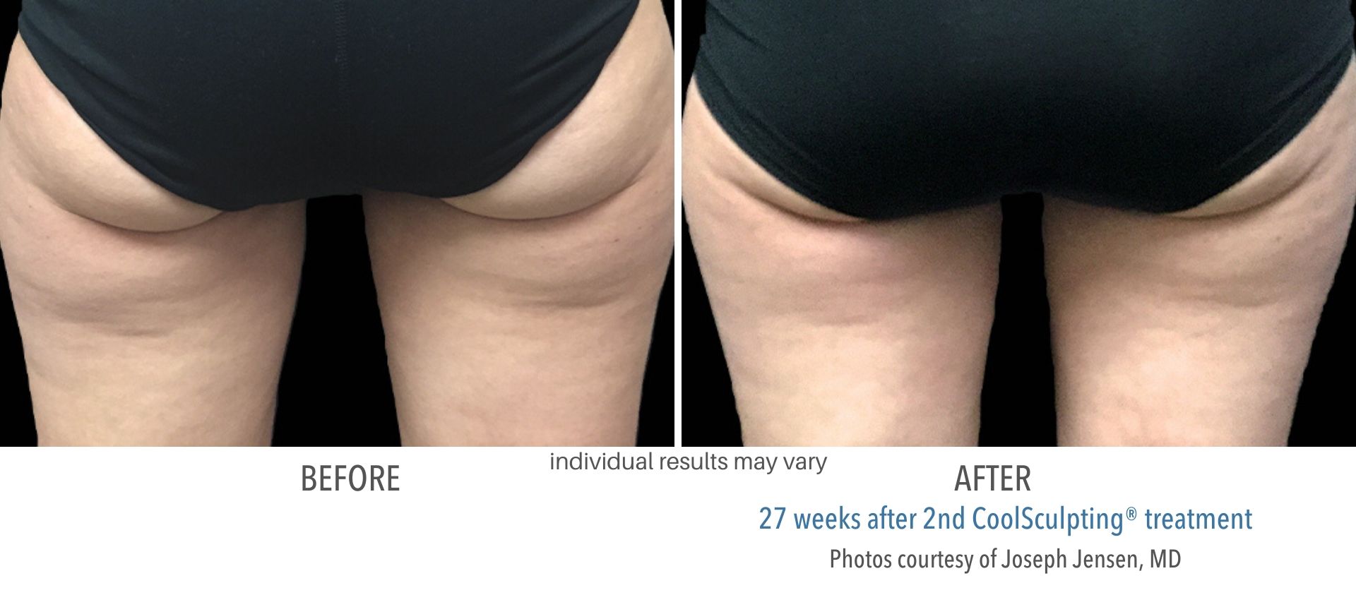 coolsculpting before and after buttocks Laser + Skin Institute in Chatham, NJ