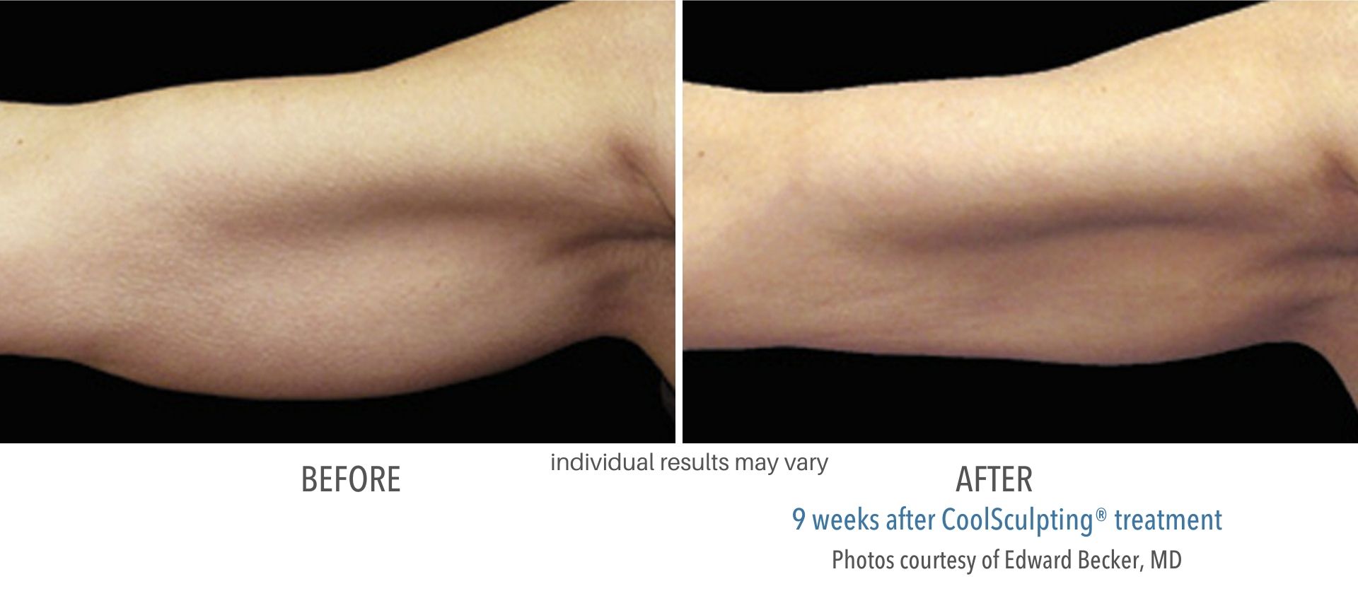 coolsculpting before and after arm fat Laser + Skin Institute in Chatham, NJ