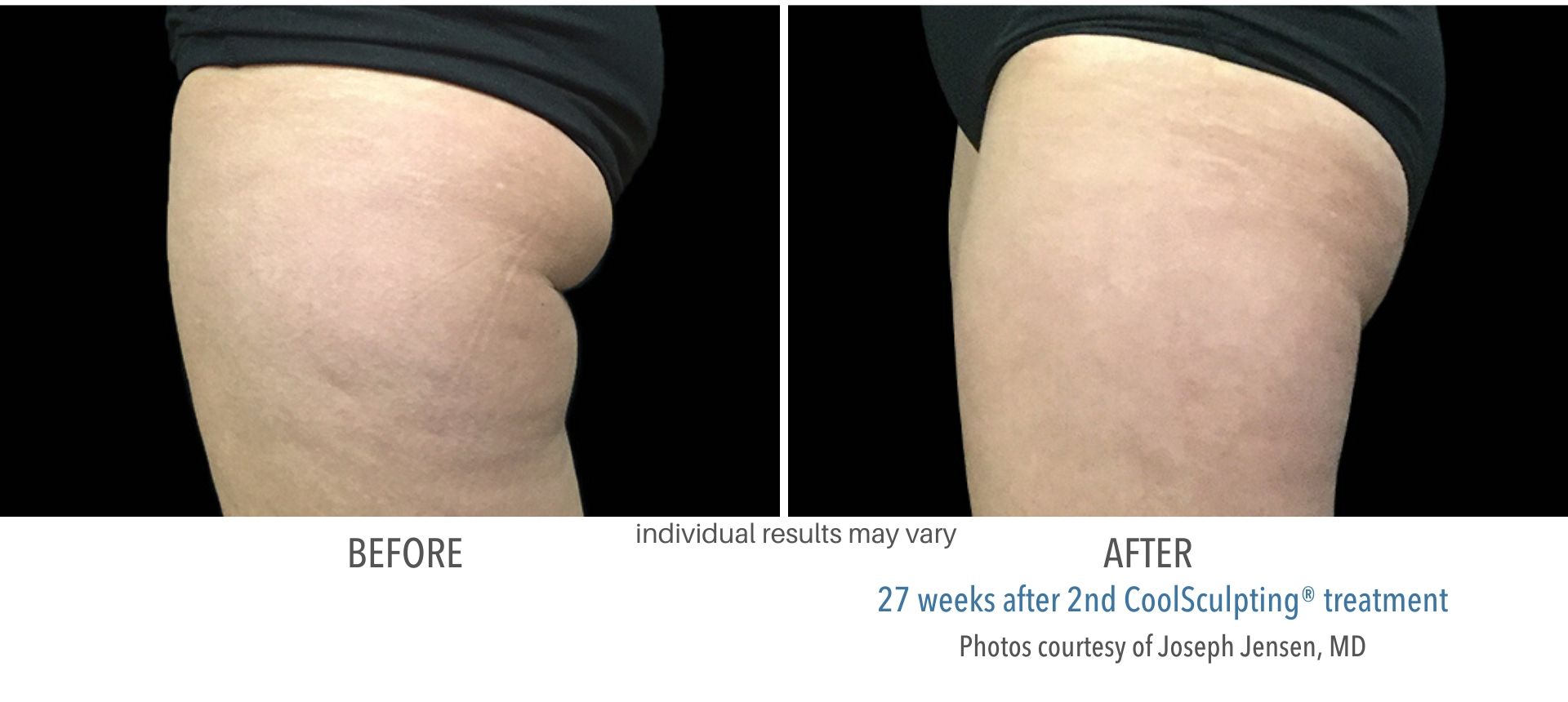 coolsculpting before and after buttocks fat Laser + Skin Institute in Chatham, NJ