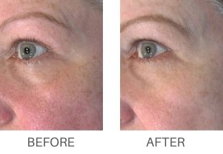 Real before and after patient results from RF MICRONEEDLING.