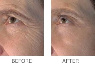 Real patient before and after results from RF MICRONEEDLING.