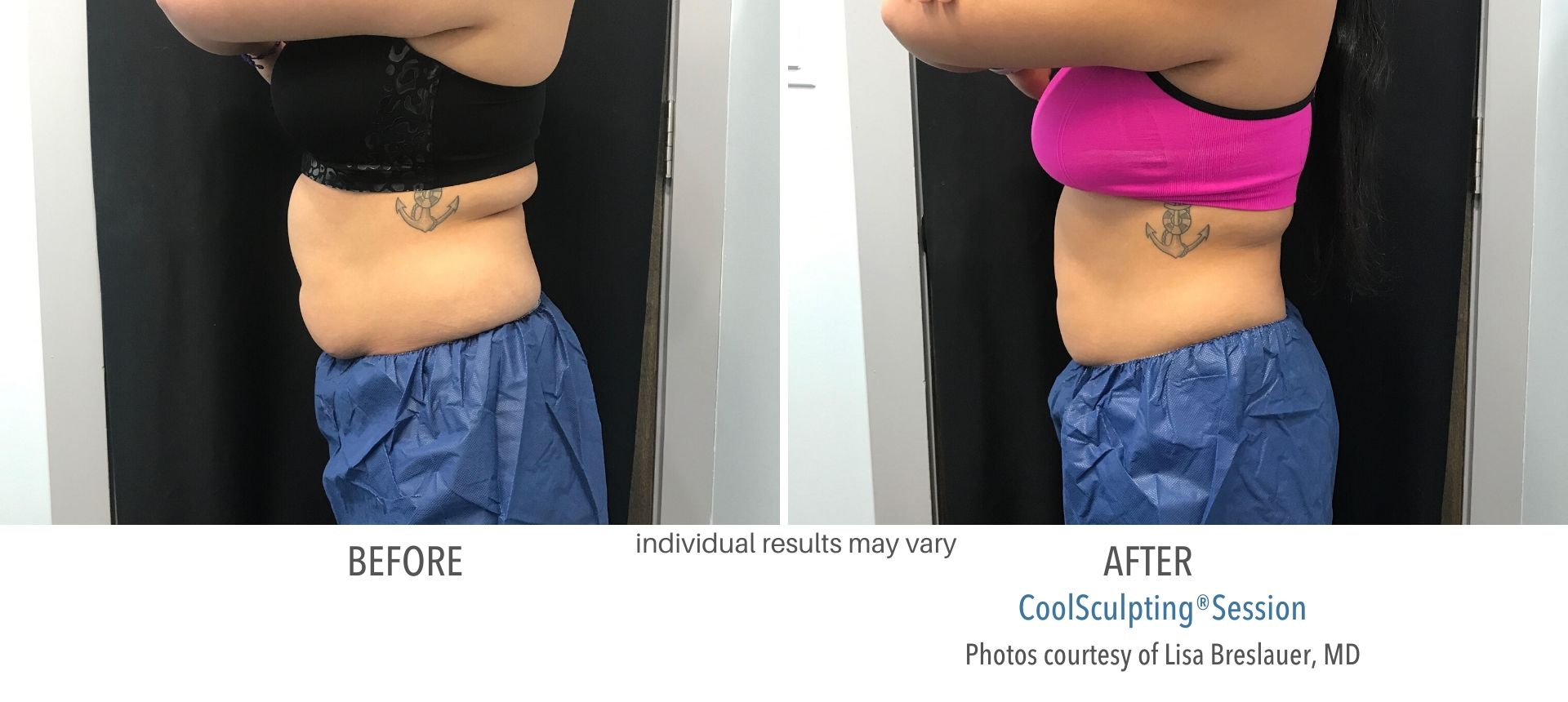 Coolsculpting before and after real result Laser + Skin Institute in Chatham, NJ.