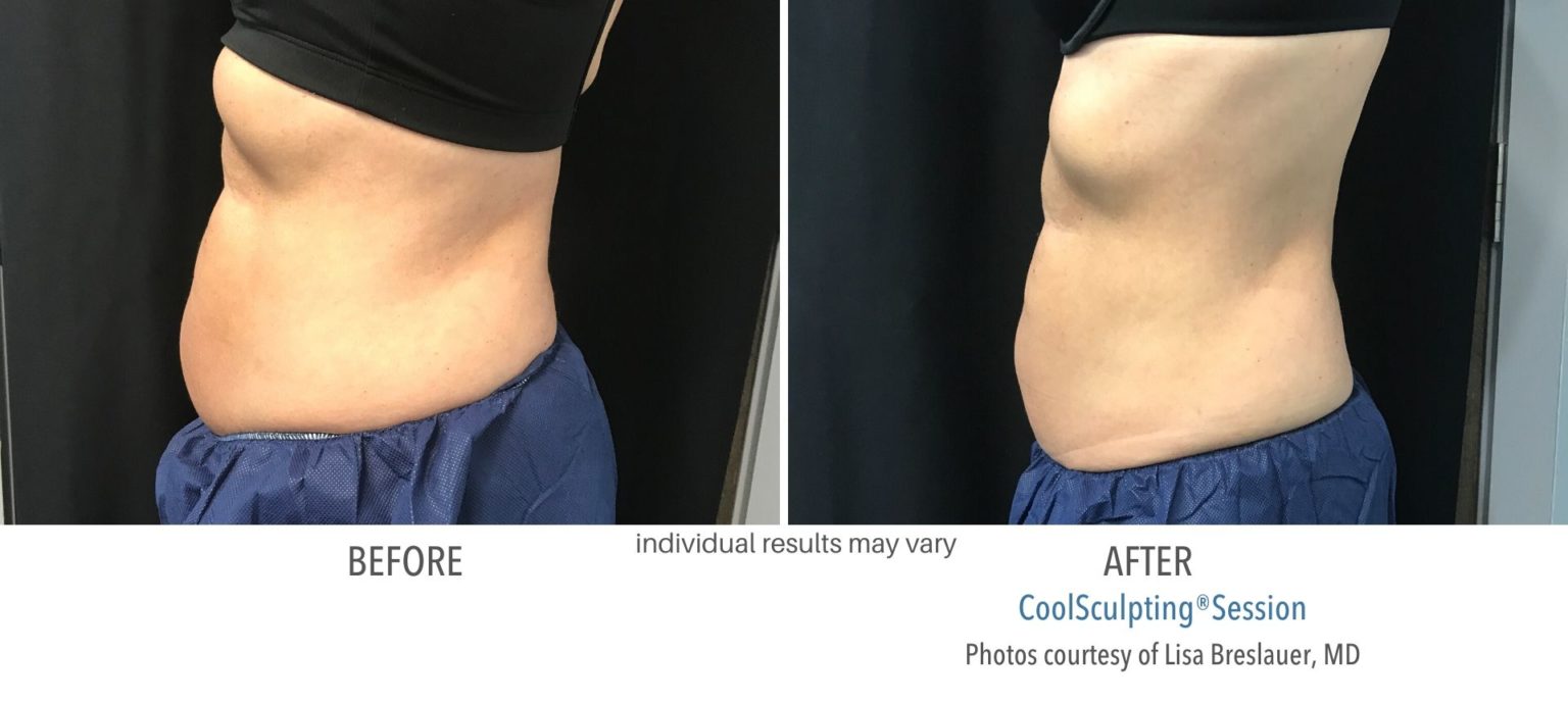 coolsculpting-freeze-away-fat-chatham-new-jersey