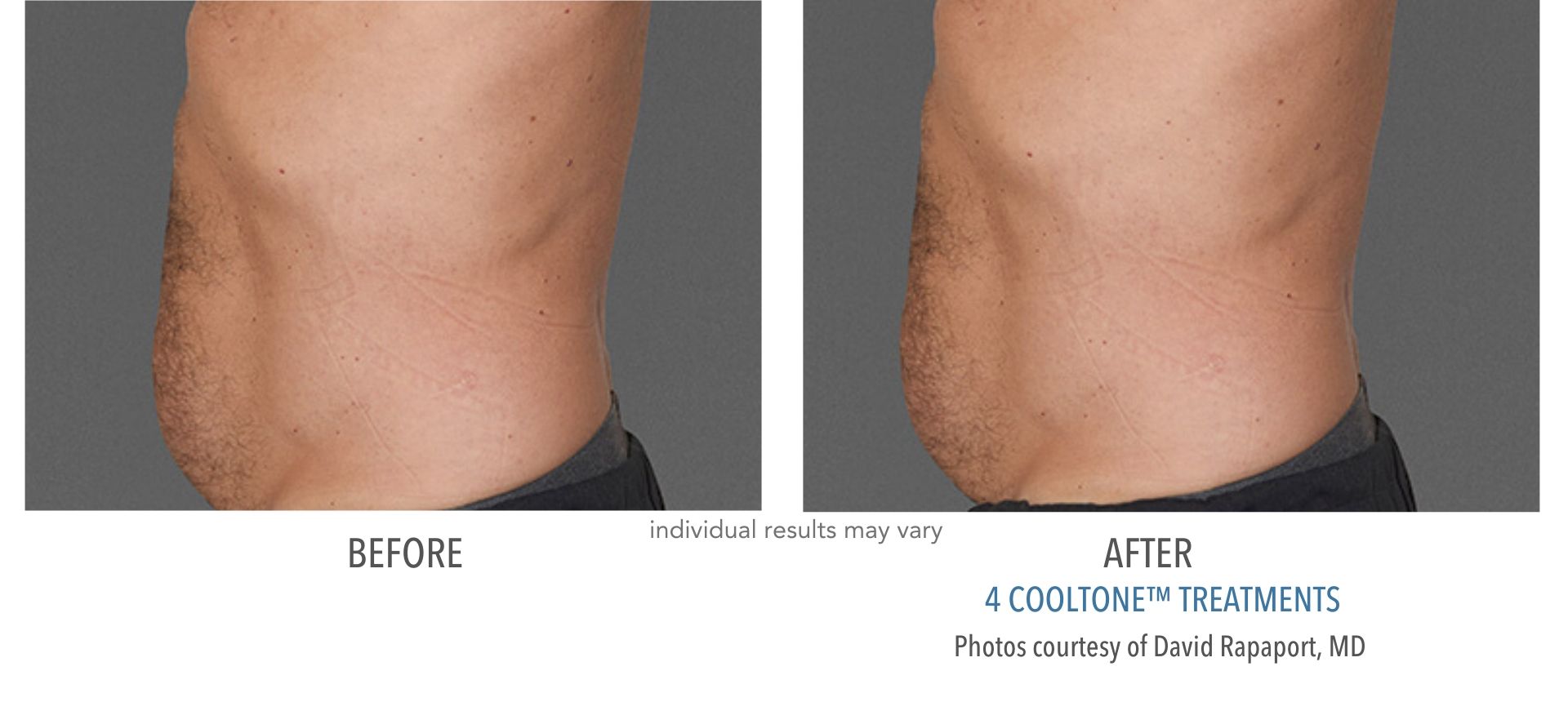 Cooltone building muscle in Laser + Skin Institute Medical and Aesthetic Dermatology