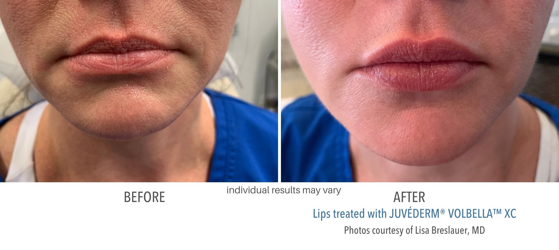 Woman's VOLBELLA XC before and after results at Laser + Skin Institute in Chatham, NJ.