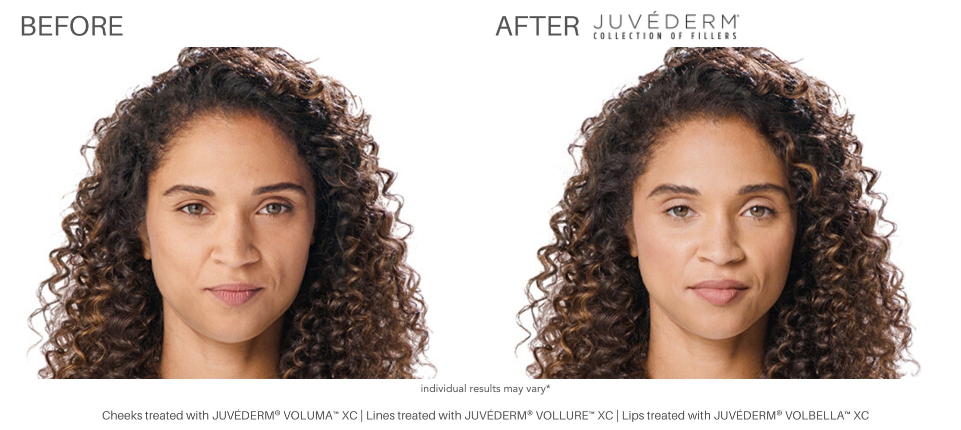 Juvéderm before and after pics in Chatham, New Jersey