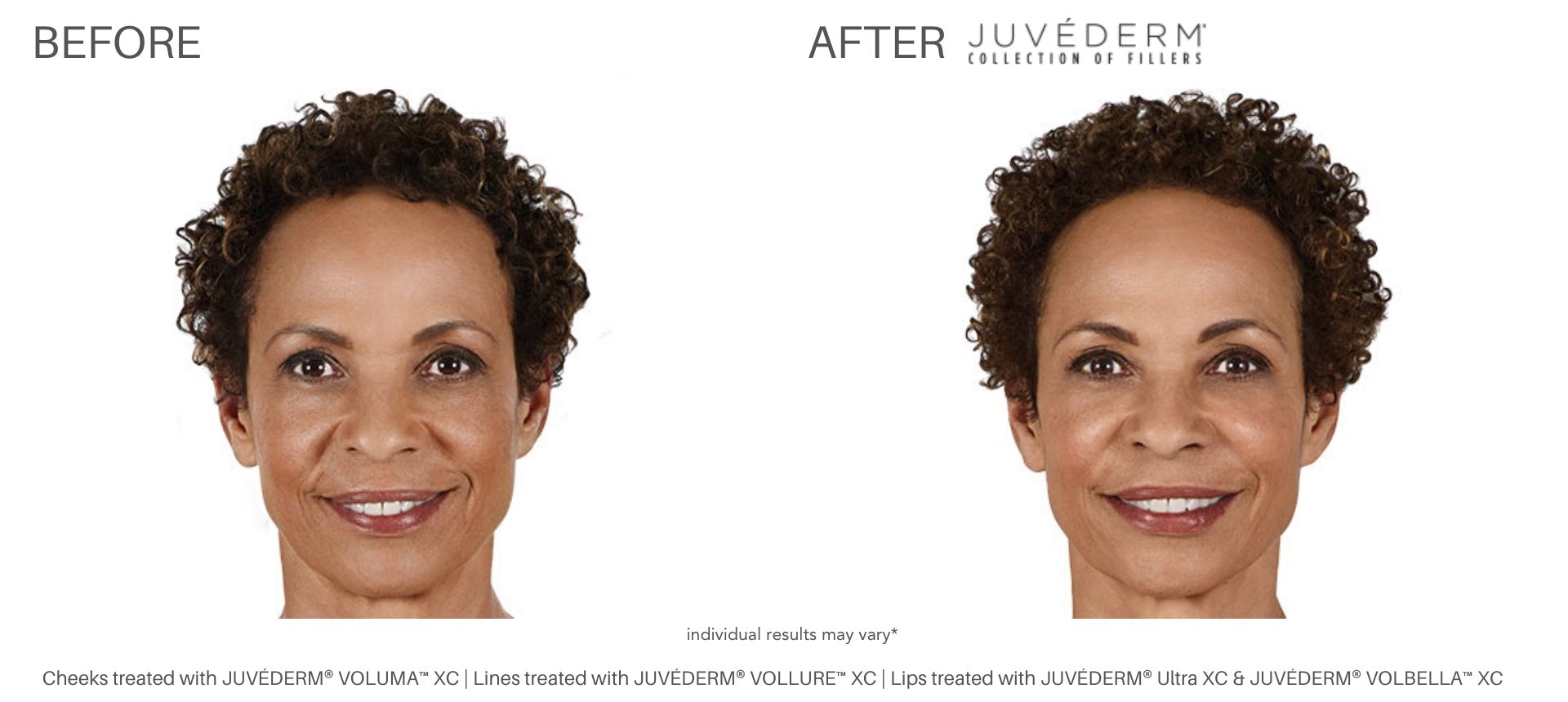 Juvéderm fillers before and after pictures Laser + Skin Institute
