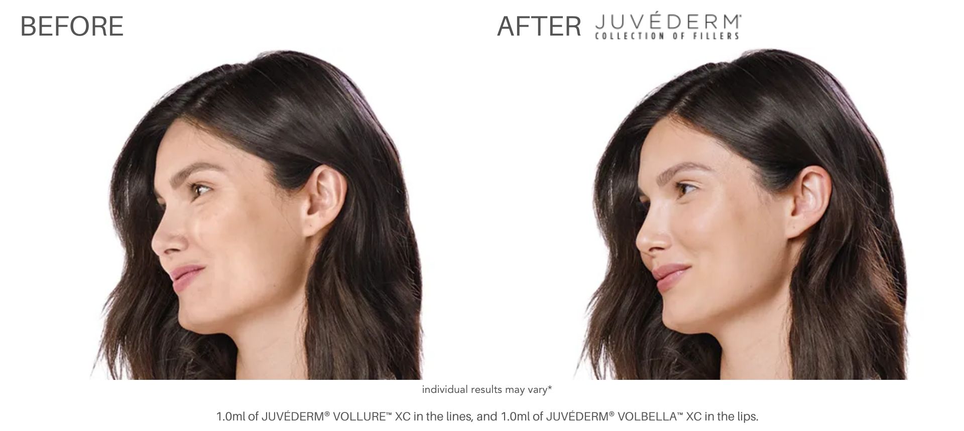 Woman's Juvéderm fillers before and after results at Laser + Skin Institute in Chatham, NJ.