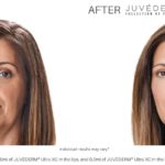 Juvéderm fillers before and after pictures Laser + Skin Institute Chatham, NJ