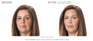 Juvéderm fillers before and after pictures Laser + Skin Institute Chatham, NJ